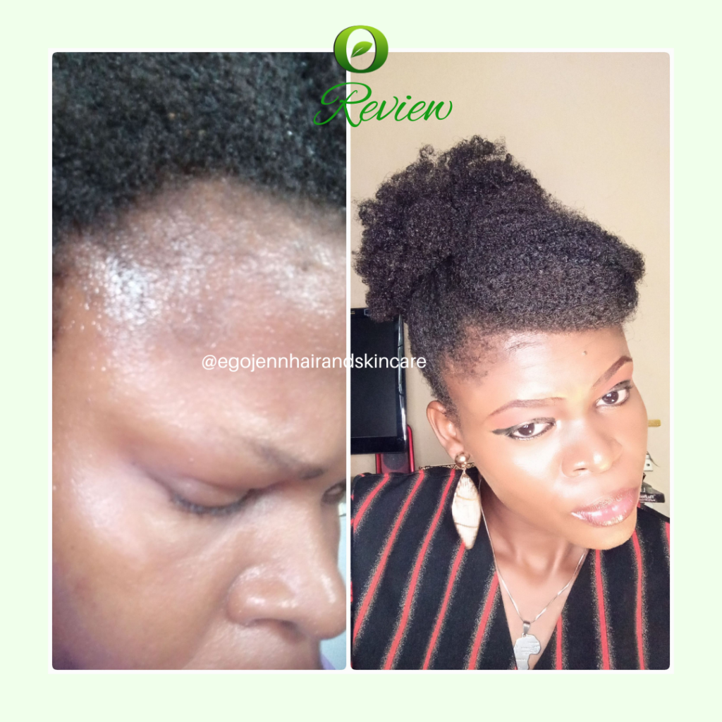 Balding edges recovery